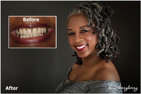 Before and After Teeth of a Woman - Tallahassee Cosmetic Dentist in Tallahassee FL