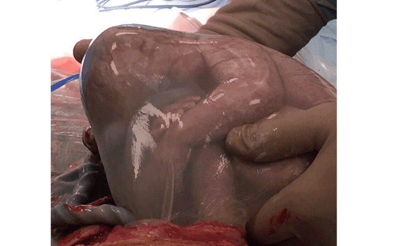 feto estratto durante taglio cesareo ancora nel suo sacco