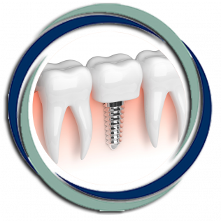 Dental implant with crown, flanked by healthy teeth, within a blue and green circular design.