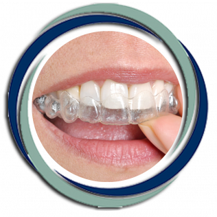 Person inserting clear aligner into teeth.