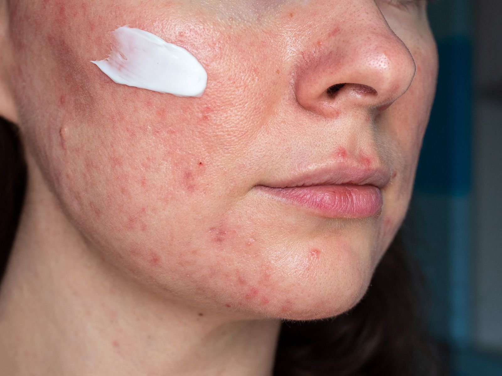 Woman with red, inflamed skin, applying cream to her cheek.