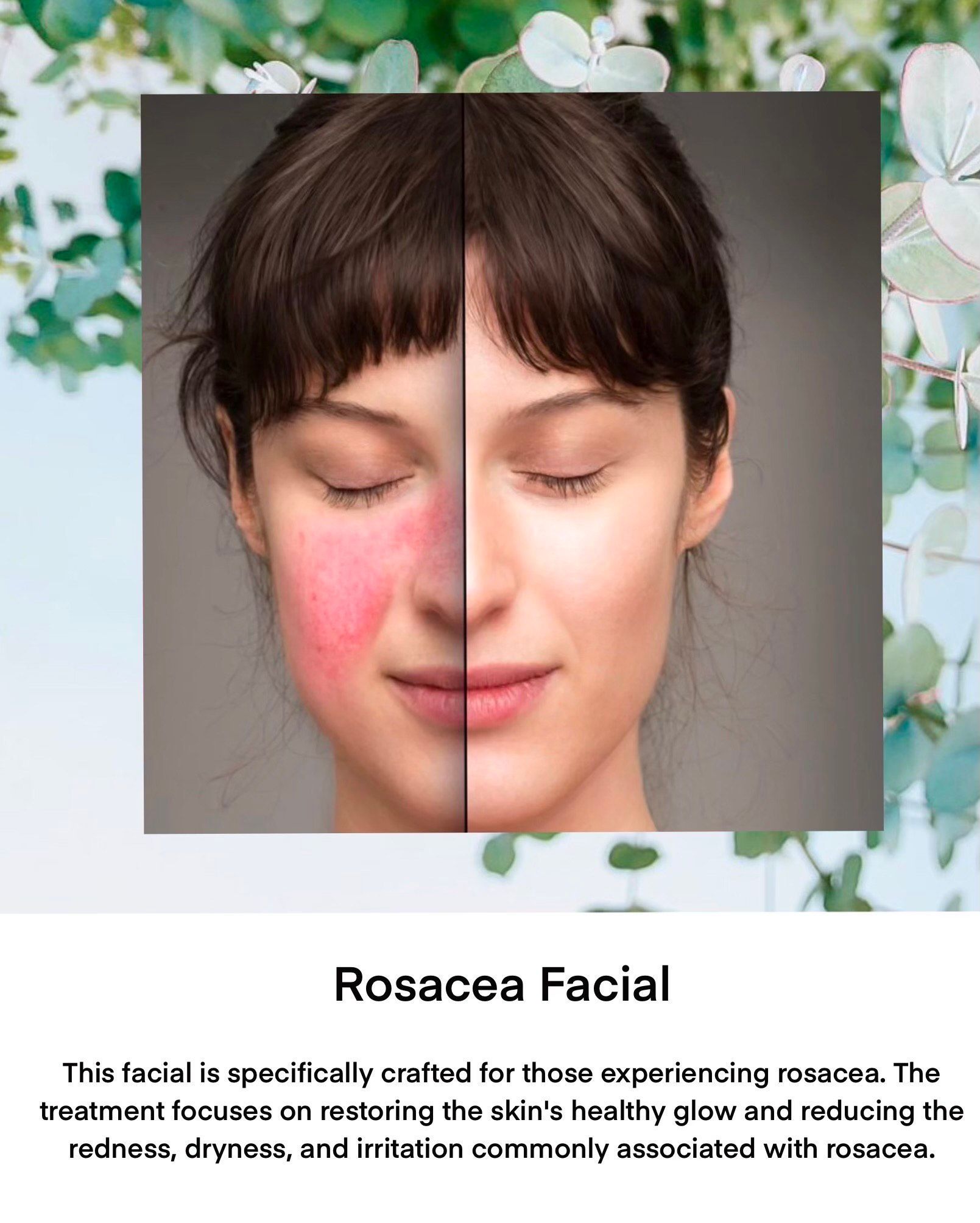 Face of a woman, one half with rosacea, the other half clear; promoting a rosacea facial treatment.