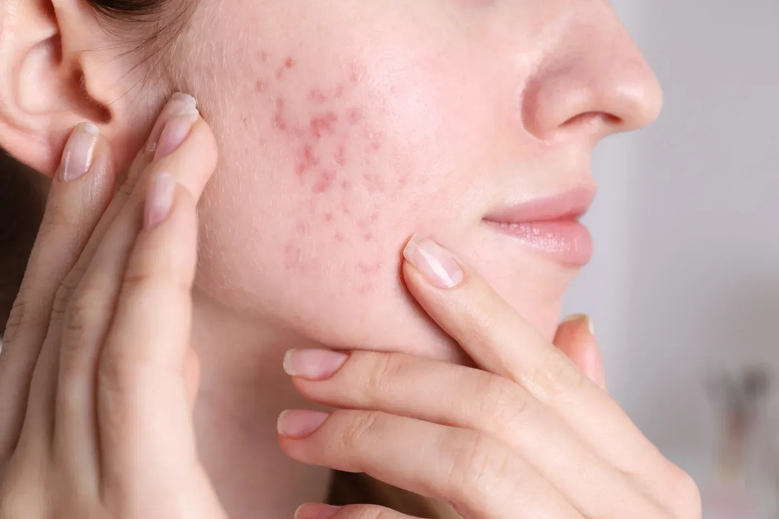 A woman with acne on her face is touching her face with her hands.