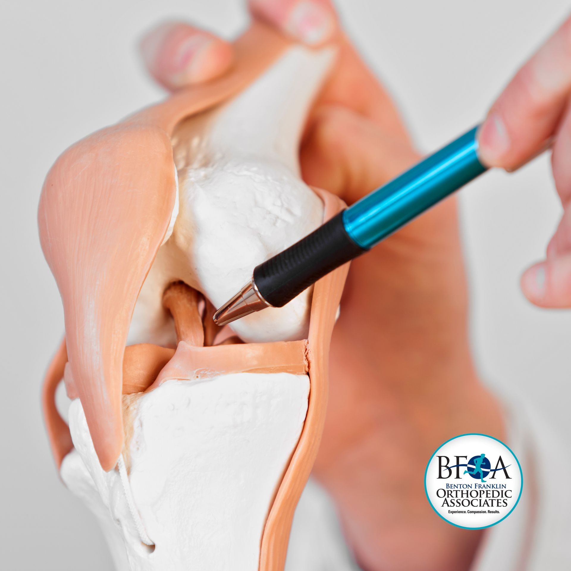 Meniscus Tear at BFOA