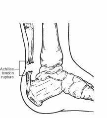 A black and white drawing of an ankle with an achilles tendon rupture.