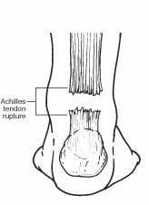 A black and white drawing of a achilles tendon rupture.