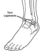 A black and white drawing of an ankle with torn ligaments.