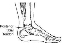 A black and white drawing of a foot with a posterior tibial tendon.