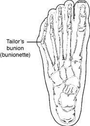 A black and white drawing of a foot with a tailor 's bunion.