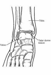 A black and white drawing of a foot with a tibia and talus.