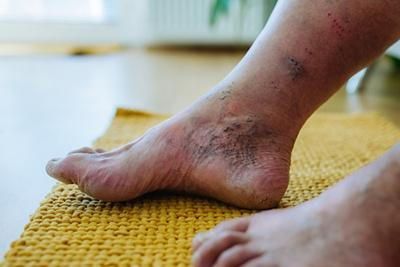 A close up of a person 's leg with varicose veins.
