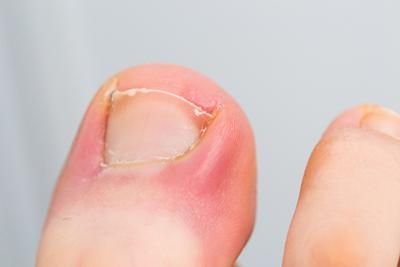 A close up of a person 's toenail with a broken nail.