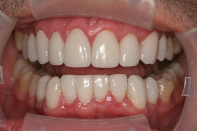 Arnold patient at E.C.O. Dental, Instant Orthodontics in Orange CA, Orthodontist Orange CA, Veneers in Orange CA