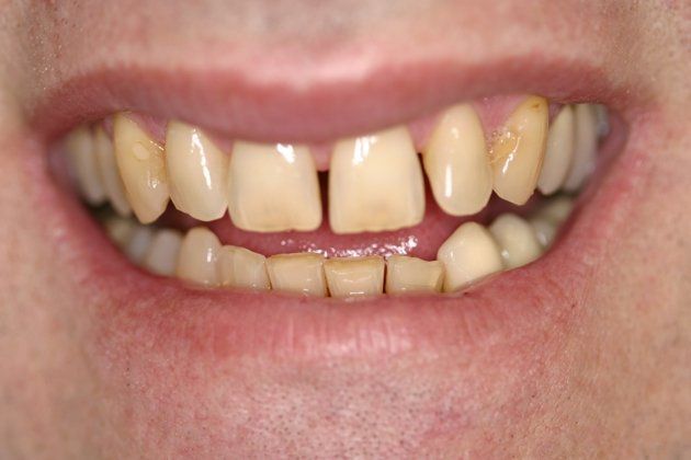Bill patient at E.C.O. Dental, Instant Orthodontics in Orange CA, Orthodontist Orange CA, Veneers in Orange CA