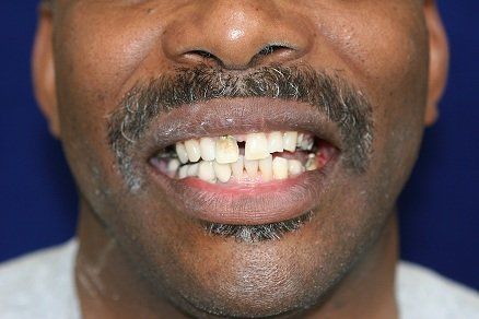 Caster, E.C.O. Dental Patient, before