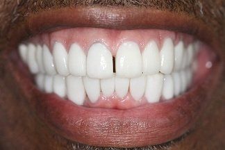 , E.C.O. Dental Patient, after results