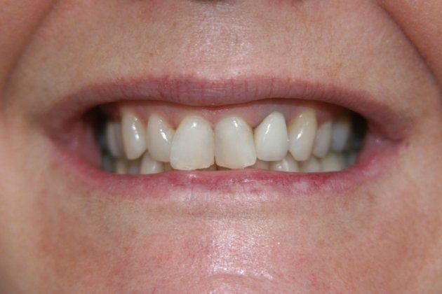 Darlene patient at E.C.O. Dental, Instant Orthodontics in Orange CA, Orthodontist Orange CA, Veneers in Orange CA