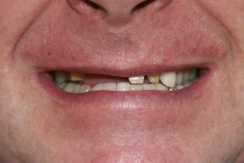 David patient at E.C.O. Dental, Full Mouth Reconstruction in Orange CA, Cosmetic Dentistry Orange CA