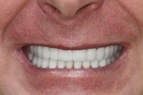 David patient at E.C.O. Dental, Full Mouth Reconstruction in Orange CA, Cosmetic Dentistry Orange CA