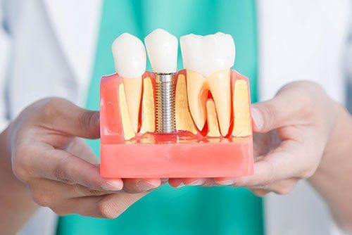 Dental Implants in Orange, CA 92866