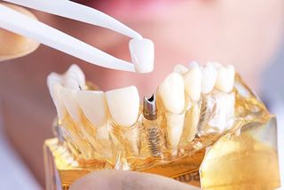 dental implants in Orange CA, Orange CA dentist