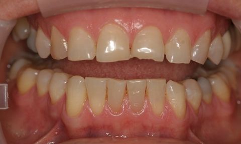 Gloria patient at E.C.O. Dental, Full Mouth Reconstruction in Orange CA, Cosmetic Dentistry Orange CA