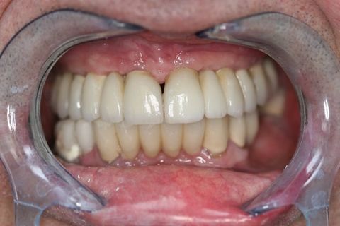 Implant bridges in Orange CA 92866, Orange CA dentist