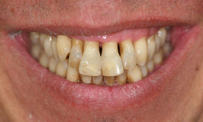 Joe patient at E.C.O. Dental, Instant Orthodontics in Orange CA, Orthodontist Orange CA, Veneers in Orange CA