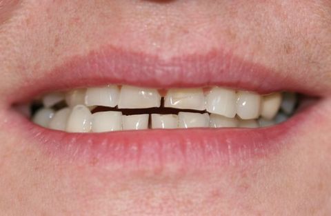 Laraine patient at E.C.O. Dental, Full Mouth Reconstruction in Orange CA, Cosmetic Dentistry Orange CA