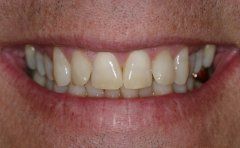 Mike patient at E.C.O. Dental, Instant Orthodontics in Orange CA, Orthodontist Orange CA, Veneers in Orange CA