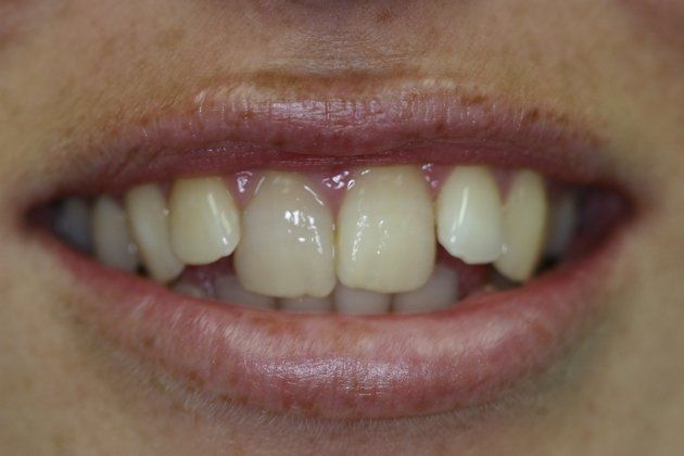 Stacy patient at E.C.O. Dental, Instant Orthodontics in Orange CA, Orthodontist Orange CA, Veneers in Orange CA
