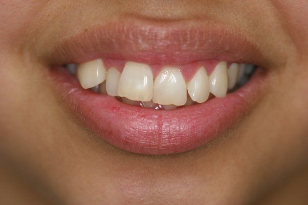 Xytlolec patient at E.C.O. Dental, Instant Orthodontics in Orange CA, Orthodontist Orange CA, Veneers in Orange CA