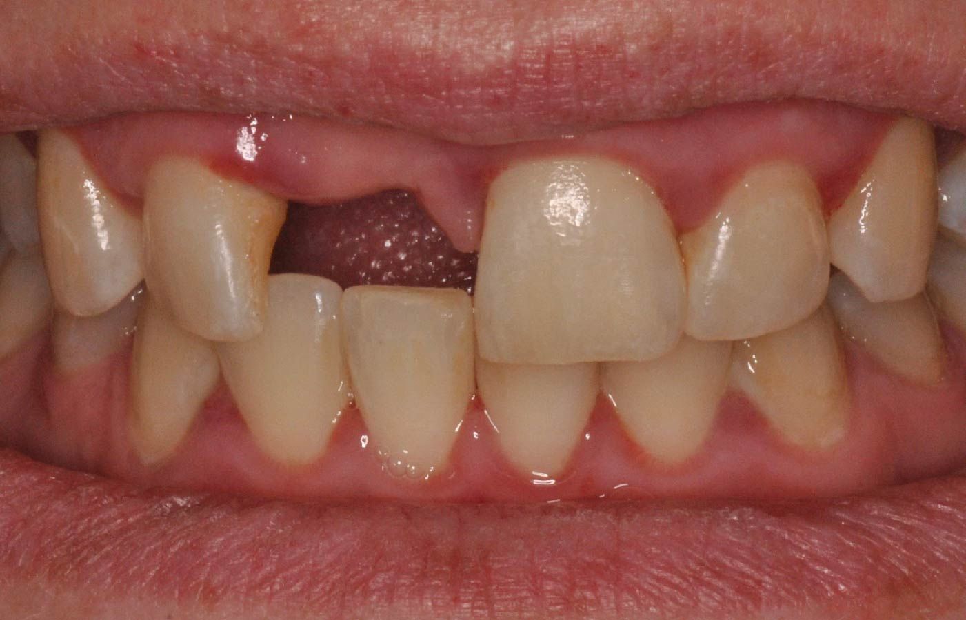 Close-up of a person's mouth with a missing tooth; exposed gum and remaining teeth visible.