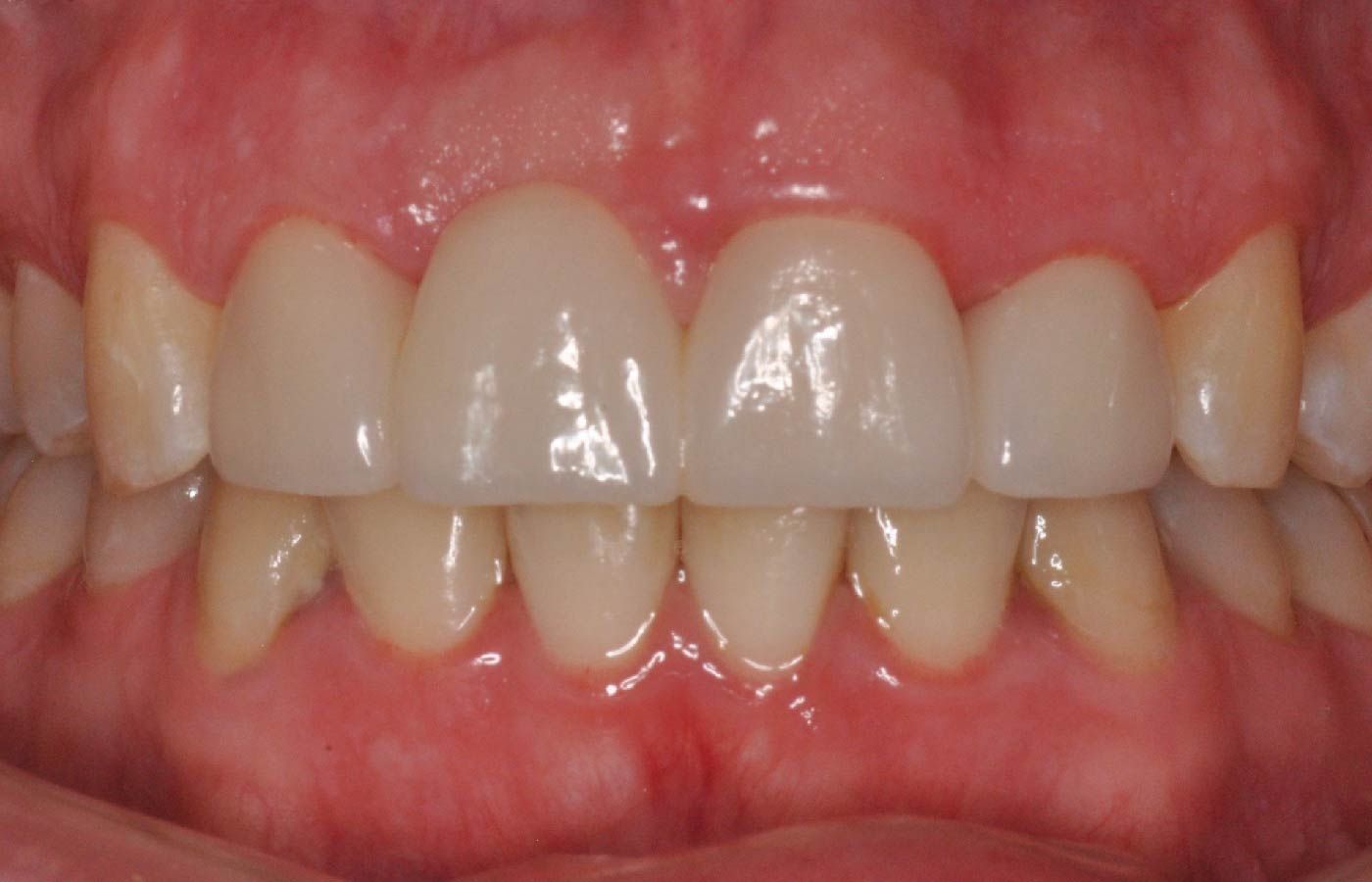 Close-up of a person's teeth. The upper front teeth are whiter than the lower ones, and the gums are pink.
