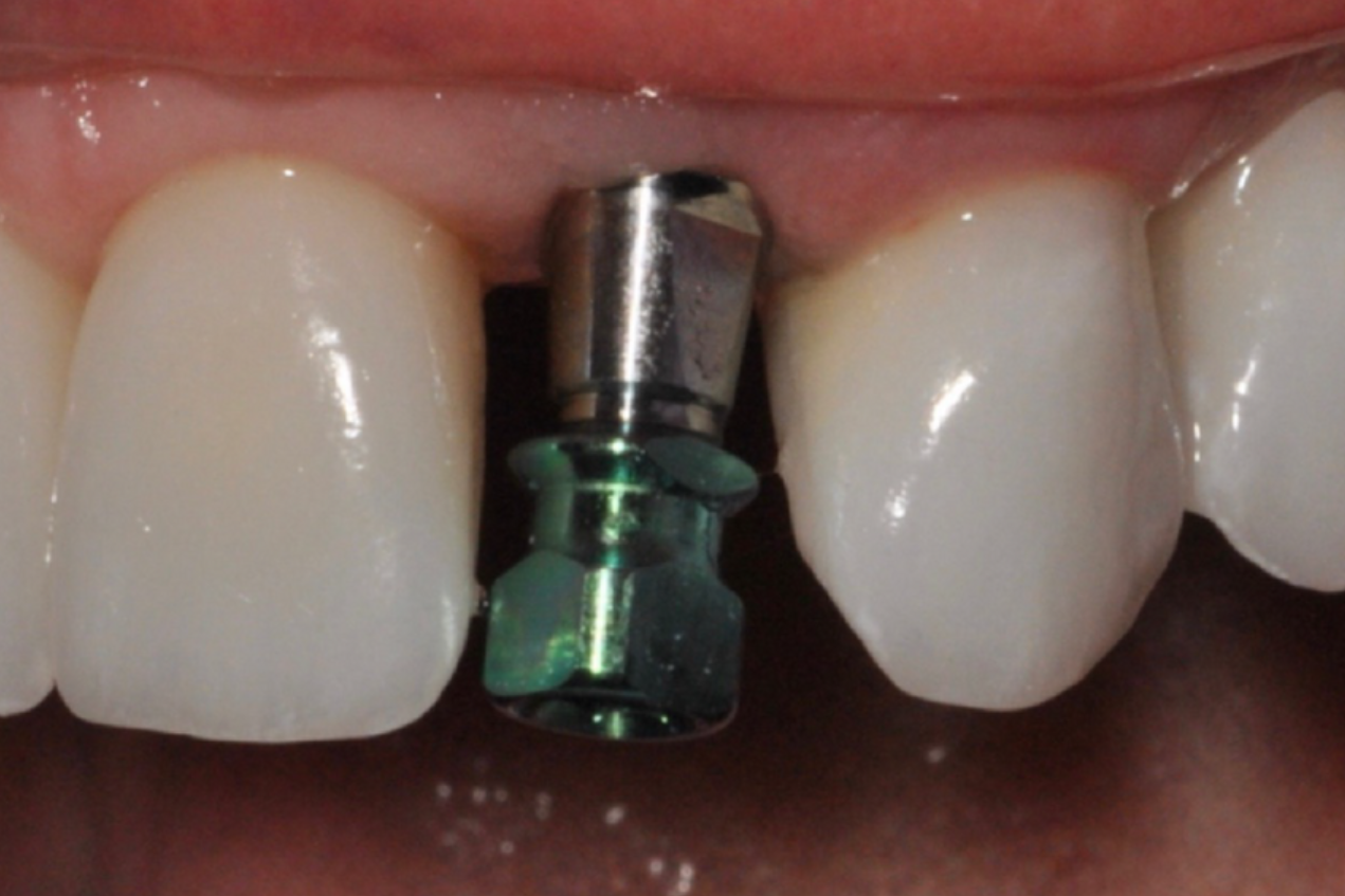 Dental implant post between two teeth. The post is metallic green and silver.