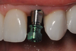 Dental implant post between two teeth. The post is metallic green and silver.