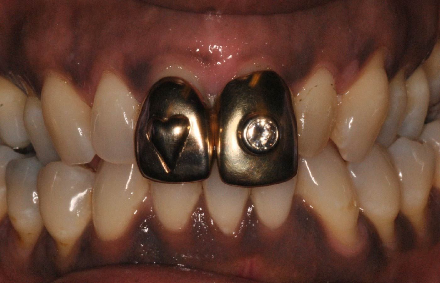 Close-up of a mouth with gold teeth caps. One has a heart, the other a gem. Other teeth are natural.