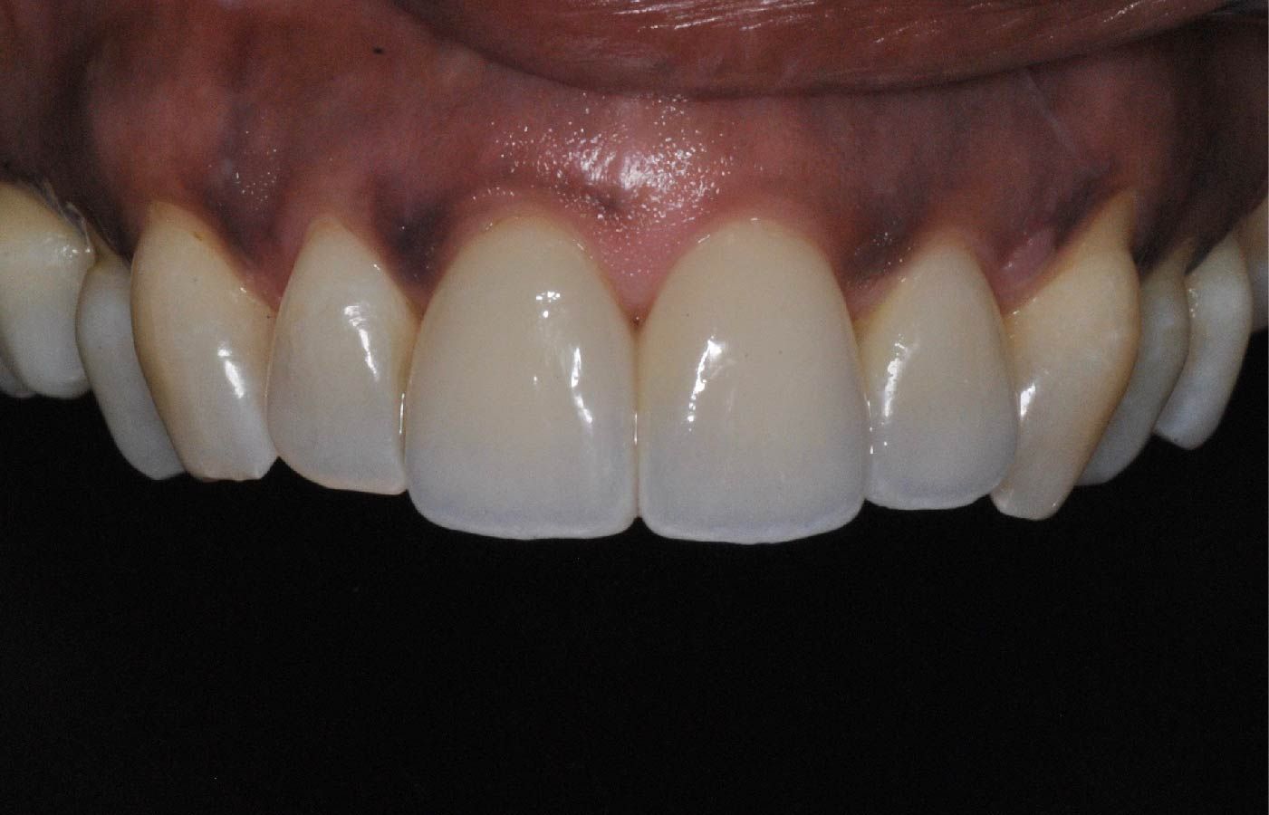 Close-up view of teeth and gums; the teeth are white and evenly spaced.