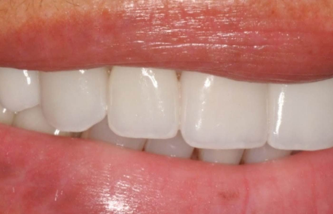Close-up of a person's mouth with bright, white, straight teeth and glossy pink lips.