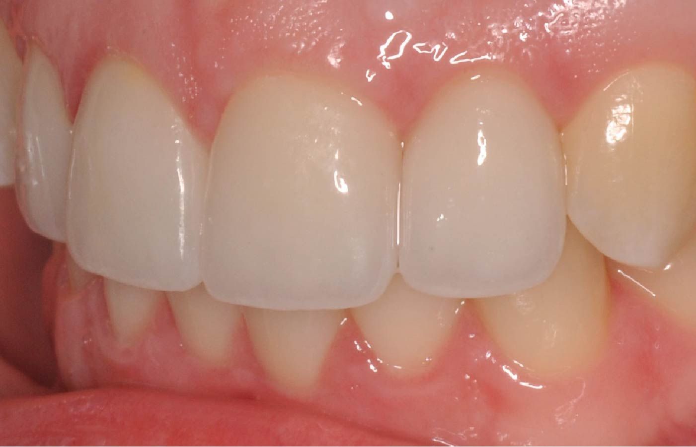Close-up of teeth with bright white crowns and healthy gums.