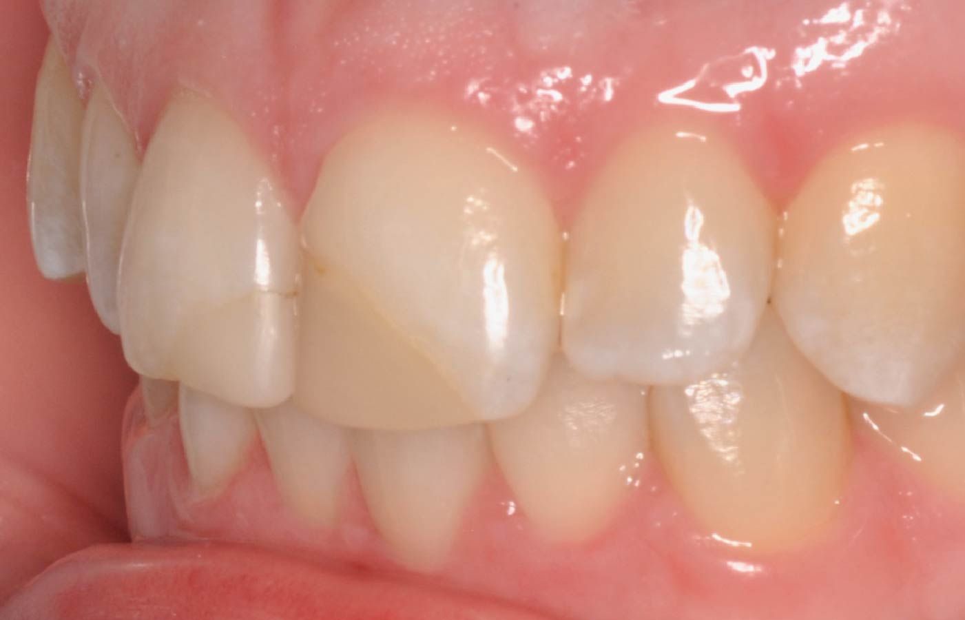 Close-up of a person's teeth showing two front teeth with slight discoloration, in a healthy, pink gum setting.