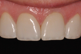 Close-up of four bright, white teeth with visible gumline.