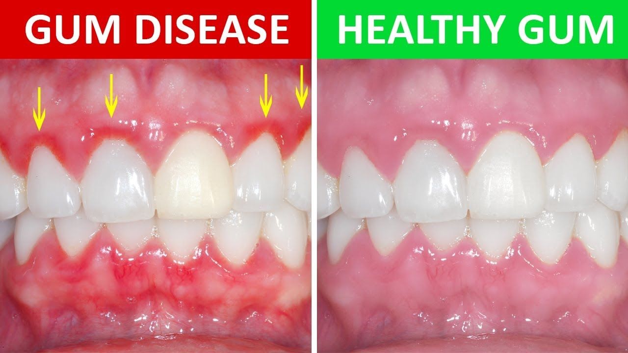 Comparison of gums: diseased gums (red, inflamed) vs. healthy gums (pink).