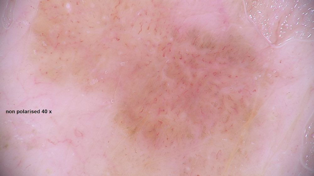 A close up of a person's face with a spot on it.