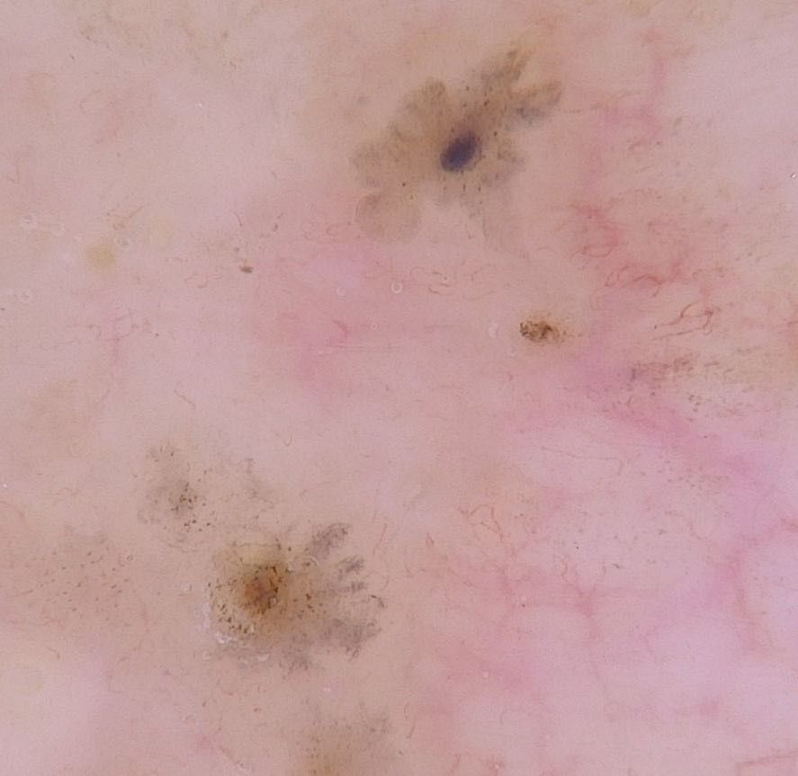 A close up of a person's skin with a few spots on it.