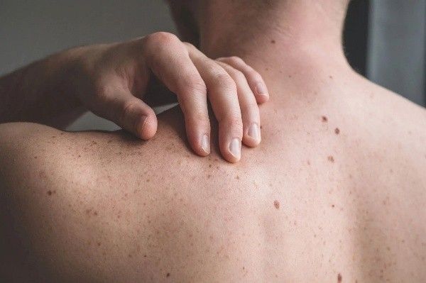 A close-up of a man's back covered in numerous freckles and moles as he touches it.