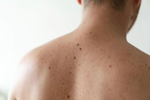 A close-up of a man's back covered in numerous freckles and moles.
