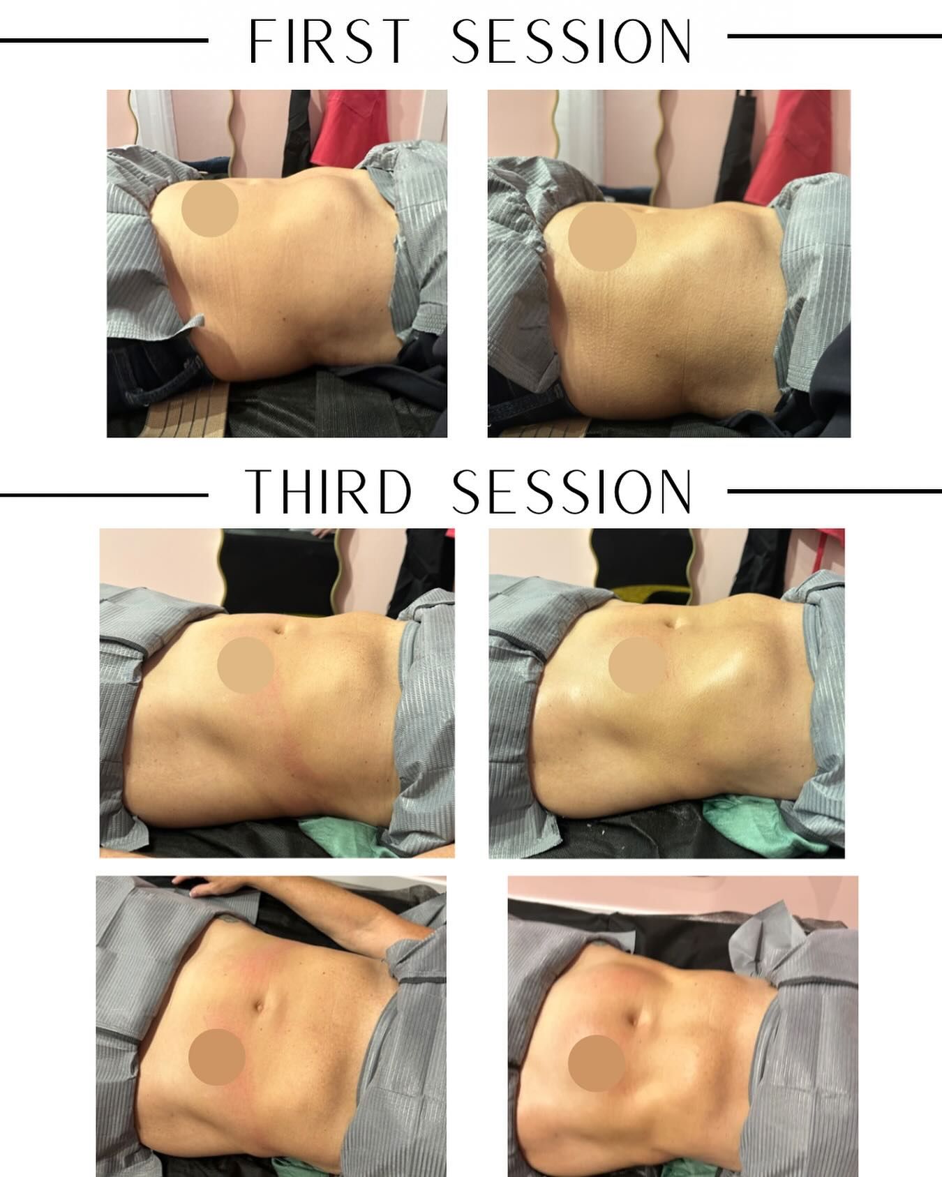 A collage of four pictures of a woman 's stomach during a first and third session.