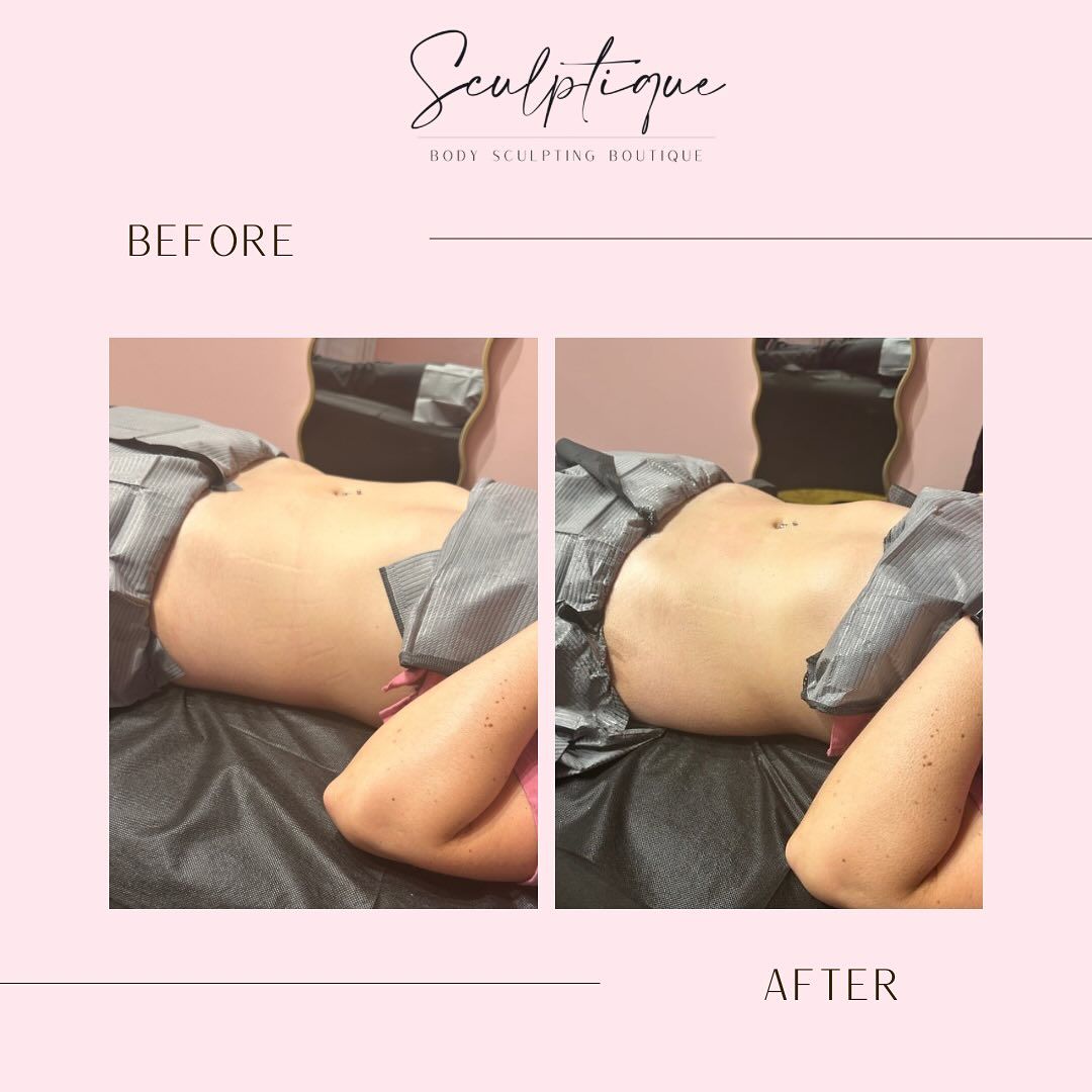 A before and after photo of a woman 's stomach.