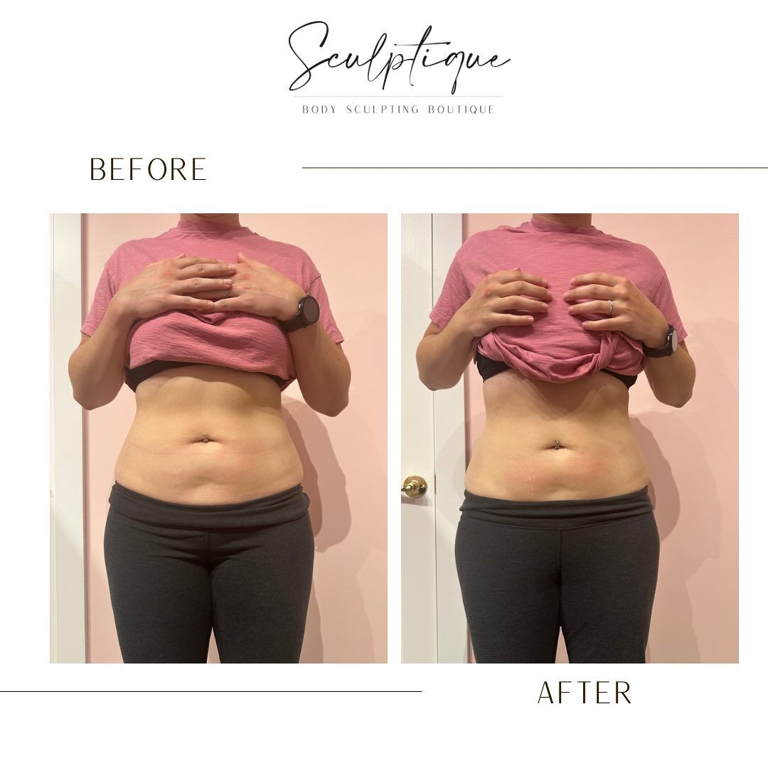 A before and after photo of a woman 's stomach.